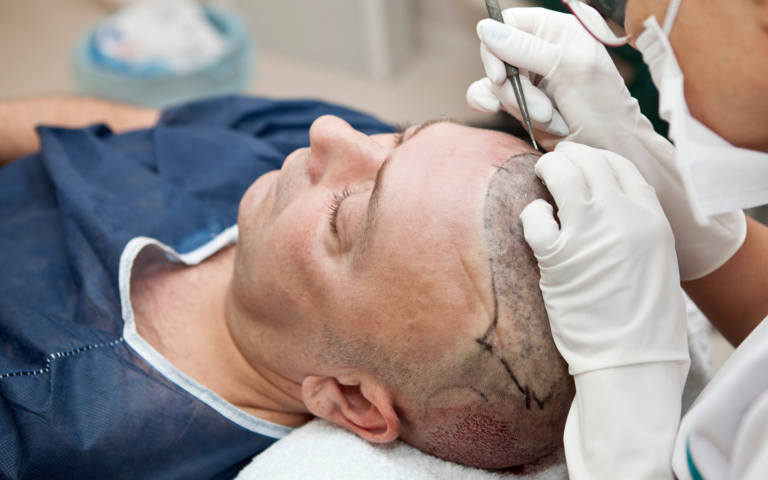 https://services.enfieldroyalsydney.com/wp-content/uploads/2022/09/hair-transplant2-768x480.webp