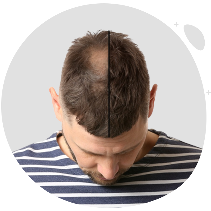 https://services.enfieldroyalsydney.com/wp-content/uploads/2022/10/hair-transplant-1.png