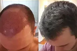 enfield royal australia before after_0000_FUT-Strip-Hair-Transplant-in-Dubai-Abu-Dhabi