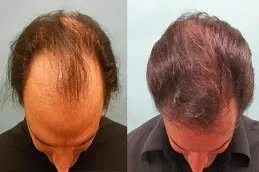 enfield royal australia before after_0001_FUT-Strip-Hair-Transplant-in-Dubai