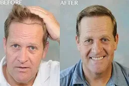 enfield royal australia before after_0002_FUT-Strip-Hair-Transplant-in-Abu-Dhabi