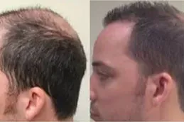 enfield royal australia before after_0003_FUT-Strip-Hair-Transplant-Dubai