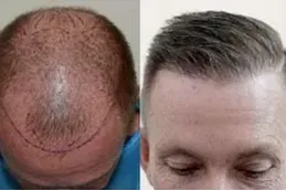 enfield royal australia before after_0004_FUT-Strip-Hair-Transplant-Clinic-in-Dubai