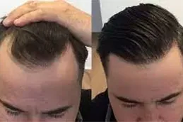 enfield royal australia before after_0006_FUE-Hair-Transplant-in-Dubai-Abu-Dhabi