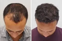 enfield royal australia before after_0007_FUE-Hair-Transplant-Clinic-in-Dubai-Abu-Dhabi-300x214